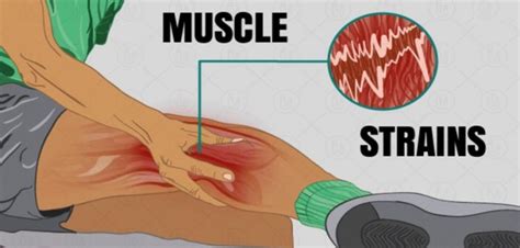 Muscle Strains Symptoms Causes And Treatment • Bodybuilding Wizard