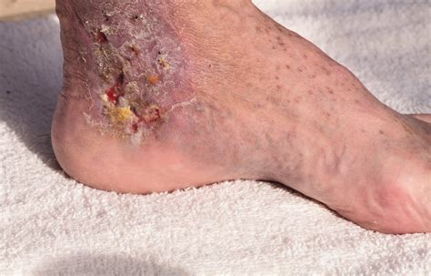 What Is Cellulitis And How To Treat It Marietta Foot Doctor