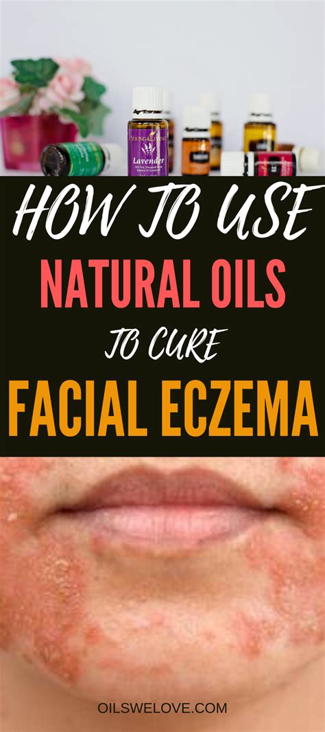 40 Natural Eczema Treatments And Remedies Natural Eczema Treatment