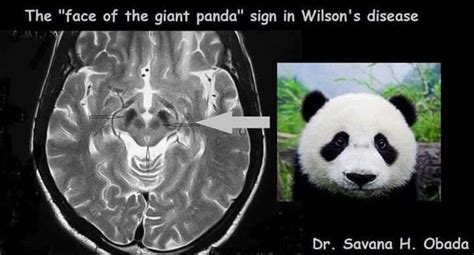 Wilsons Disease Giant Panda Sign Medical Surgical Nursing Wilsons