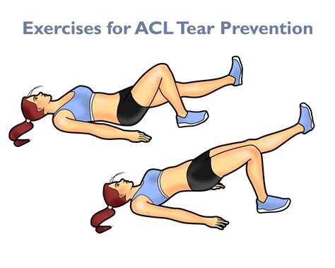 ACL Injury Prevention Top Exercises And Tips ACL Injury Recovery