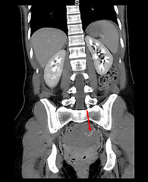 Ct Axial View Of The Pelvis Showing Extravasation Of Contrast