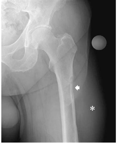 An Anteroposterior Radiograph Of The Hip And Thigh Shows A Soft Tissue