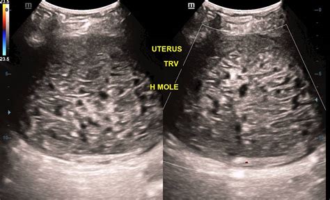 Complete Hydatidiform Molar Pregnancy Image Radiopaedia Org