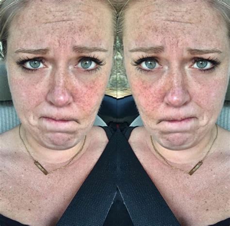 Woman Learning To Love Her Freckles Uses Body Positive Approach