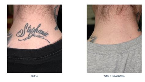 Dermatologist Tattoo Removal Denver Hortense Corrigan