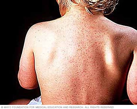 We did not find results for: Roseola - Symptoms and causes - Mayo Clinic