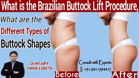 What Is The Brazilian Buttock Lift Procedure What Are The Different