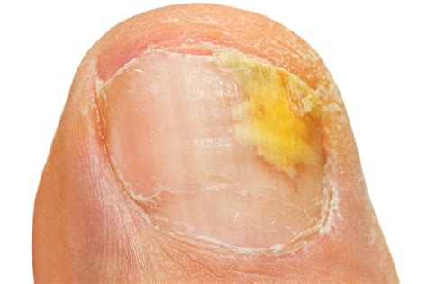 Laser Treatment For Fungal Nail Infection Onychomycosis