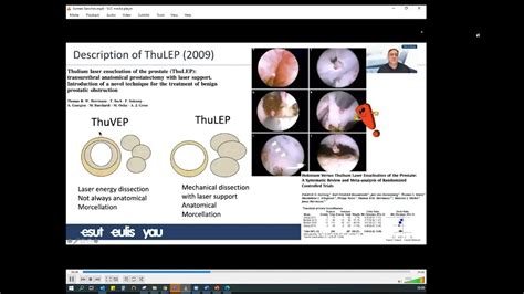 UROwebinar Laser Endoscopic Anatomic Enucleation Of Prostate AEEP YouTube