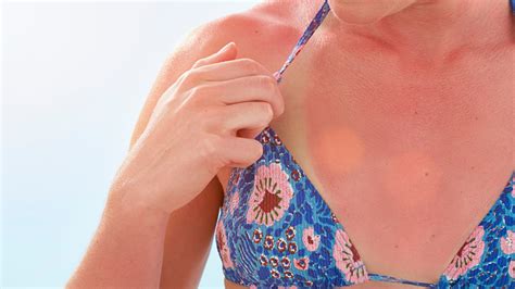 Doctors Warn Of Rare Sunburn Reaction ‘hells Itch That Feels Like ‘ants Under The Skin