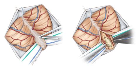 Suboccipital Craniotomy The Neurosurgical Atlas By Aaron Cohen Gadol