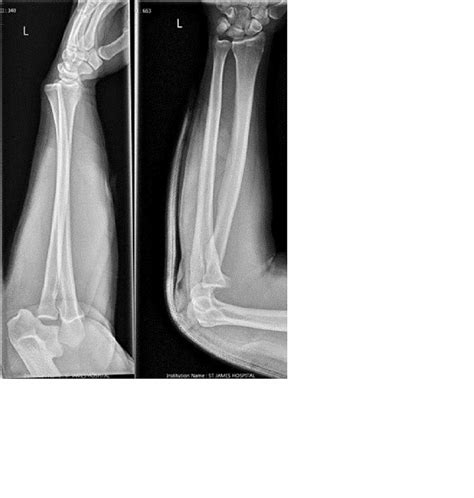 Cureus An Unusual Case Of Anterior Elbow Dislocation Without Bony Injury