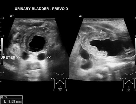 [view 19 ] Get Antenatal Posterior Urethral Valve Radiology Pictures Vector