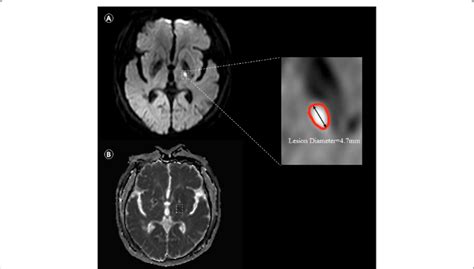 Illustrative Image Of The Acute Subcortical Cerebral Microinfarcts