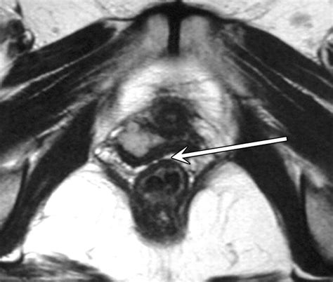 Mr Imaging Features Of Vaginal Malignancies Radiographics