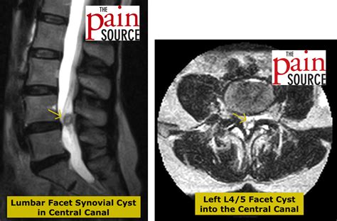 Lumbar Facet Joint Synovial Cyst The Pain Source