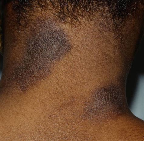 10 Most Common Skin Rashes On Black Skin Hives On Black Skin