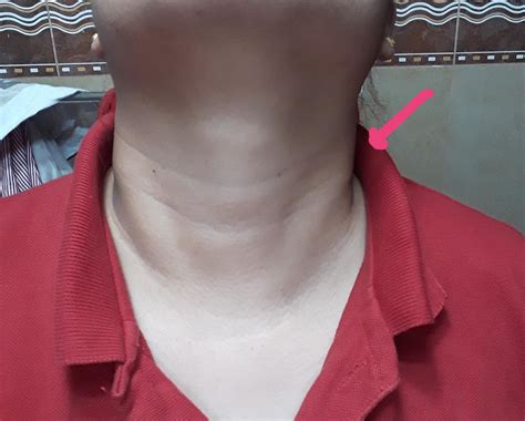 Few Weeks Ago I Noticed My Left Side Neck Is Swollen I Don T Know If This Is A Muscle Knot Or