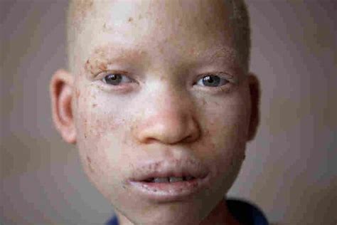 Portraits Of Albinism Letting An Inner Light Shine Albinism Albino