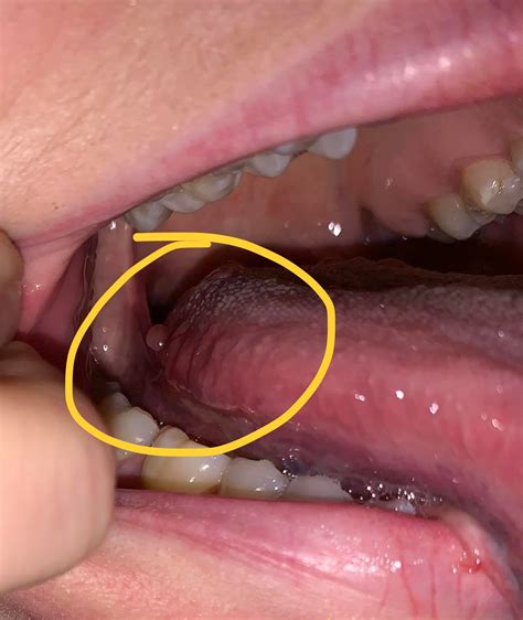 Painful Bump On Side Of Tonguejust Noticed It Today Diagnoseme