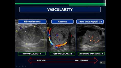 Pin On Breast Imaging