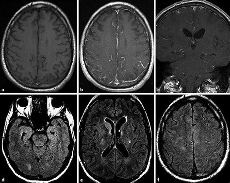 Mri Of The Brain With And Without Contrast A T1 Precontrast Axial