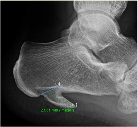Lateral Heel Radiograph Showing The Spur Length A Oblique Line