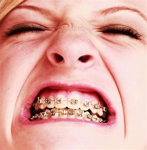 Filefree Awesome Girl With Braces Close Up Wikimedia Commons