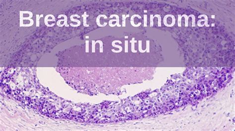 Breast Carcinoma In Situ Pathology Mini Tutorial Youtube