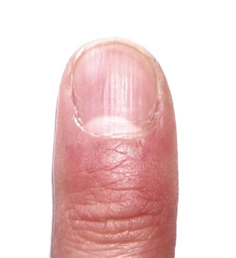 Psoriasis Of A Fingernail Psoriasis Image Psoriasis Pictures Psoriasis