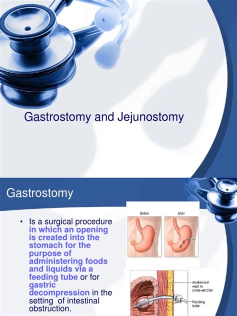 Gastrostomy And Jejunostomy Pdf Intravenous Therapy Medicine