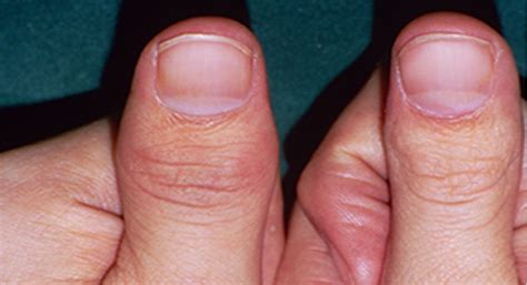 Signs And Symptoms Of Psoriatic Arthritis Take The Quiz
