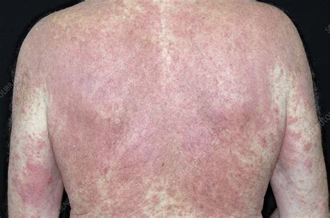 Eczema On The Torso Stock Image C0051841 Science Photo Library