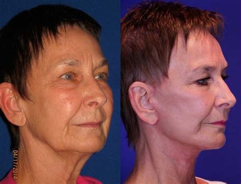 Judith 70 Before And After Facelift Reflection Lift Results Judith