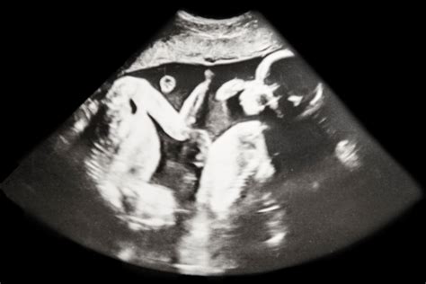 Twins Ultrasound Images Two Views