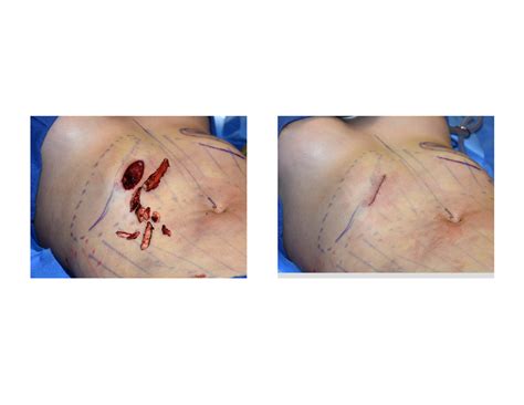 This is an introduction to the back. Plastic Surgery Case Study - Subcostal Rib Removals for Vertical Waistline Lengthening - Explore ...