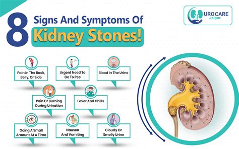 8 Signs And Symptoms Of Kidney Stones