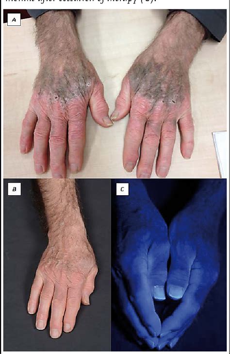 Figure 2 From Cutaneous Hyperpigmentation Induced By Doxycycline A
