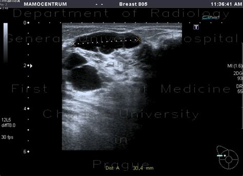 Radiology Case Breast Cyst