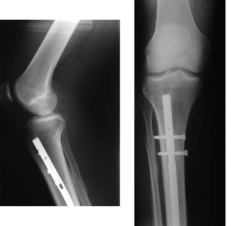 Bone Fracture Treatment Bone Fracture And Repair