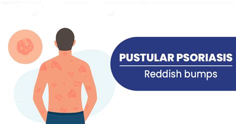 What Is Pustular Psoriasis Types And Treatments Star Health