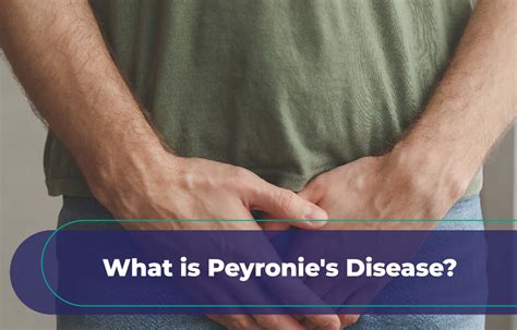 What Is Peyronies Disease Its Causes Symptoms And Treatment