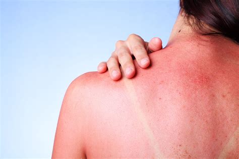 Sunburn Treatment For Pain Free Summer Fort Healthcare