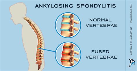 How To Treat Ankylosing Spondylitis Mass4d Foot Orthotics