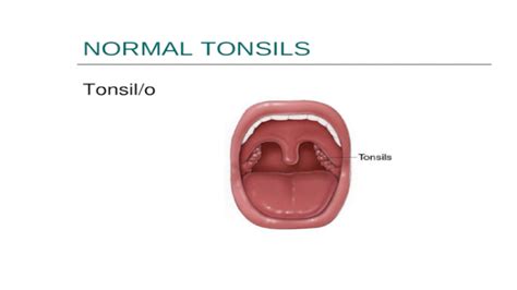 Chapter 3 Medical Terminology Normal Tonsils Tonsilo