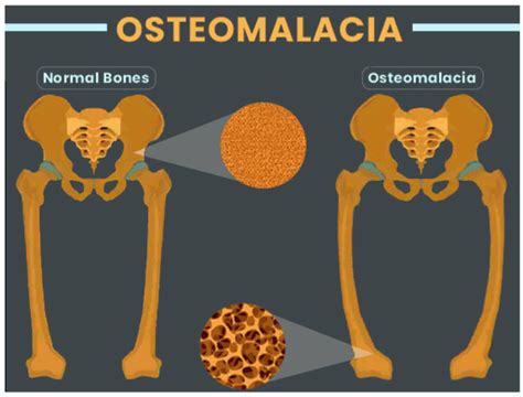 Metabolic Bone Disease Symptoms Causes Diagnosis Treatment And