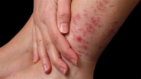 Mommy Medicine Treating Eczema And Other Rashes