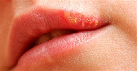 Herpes labial Qué causa las calenturas labiales Tratamientos
