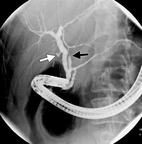 Management Of Iatrogenic Bile Duct Injuries Role Of The Interventional